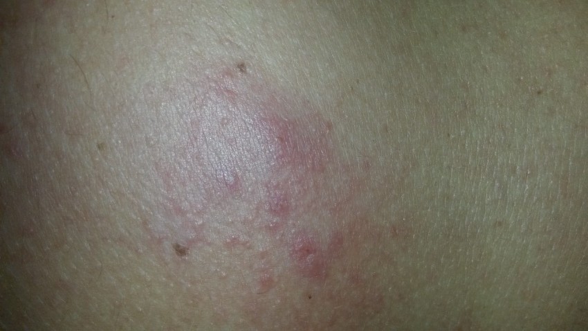 Прыщи у мужчин - причины появления, советы как избавиться, ошибки диагностики и удаления (95 фото)