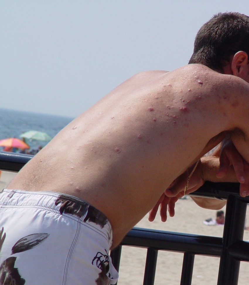 Прыщи у мужчин - причины появления, советы как избавиться, ошибки диагностики и удаления (95 фото)