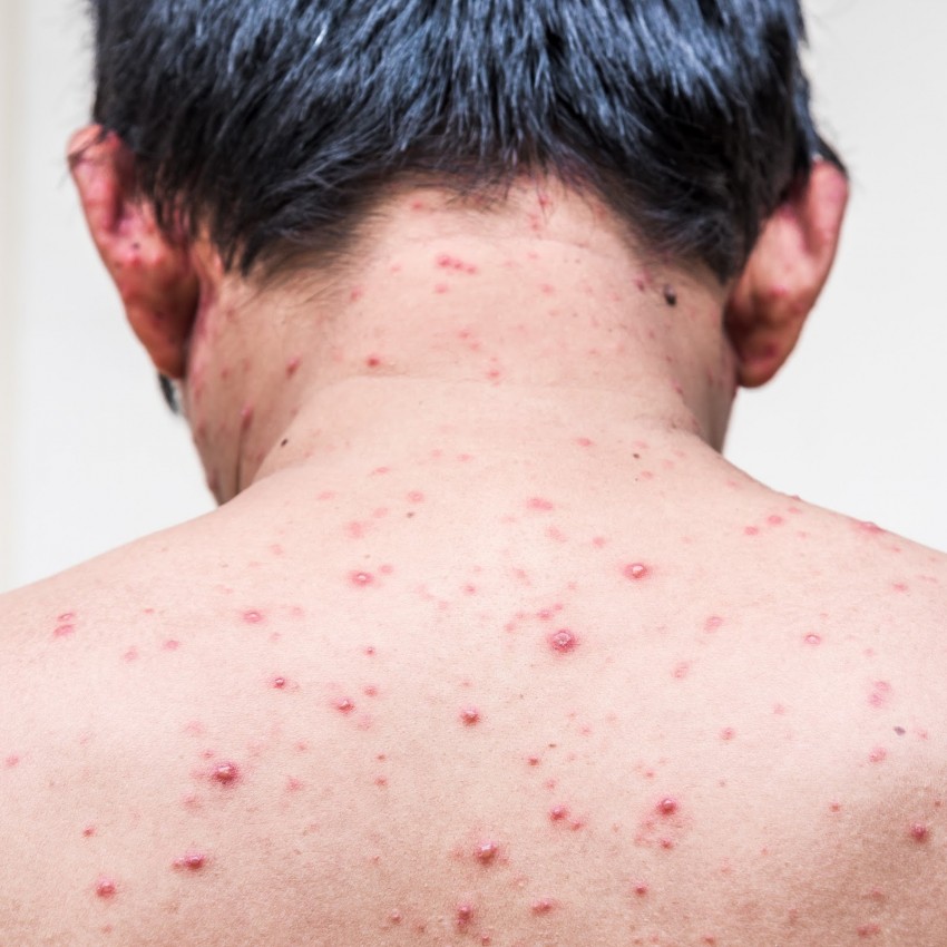 Прыщи у мужчин - причины появления, советы как избавиться, ошибки диагностики и удаления (95 фото)