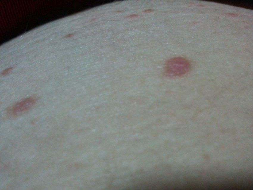 Прыщи у мужчин - причины появления, советы как избавиться, ошибки диагностики и удаления (95 фото)