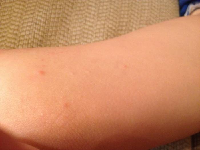 Прыщи у ребенка: 125 фото, поиск причины, варианты лечения проблемы с кожей и принципы лечения болезней кожи