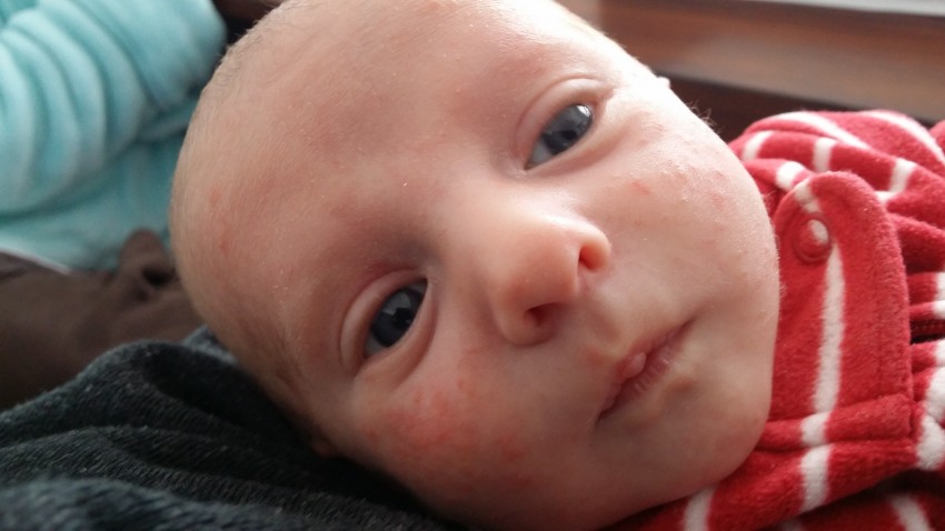 Прыщи у ребенка: 125 фото, поиск причины, варианты лечения проблемы с кожей и принципы лечения болезней кожи