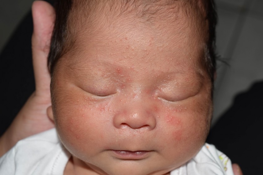 Прыщи у ребенка: 125 фото, поиск причины, варианты лечения проблемы с кожей и принципы лечения болезней кожи