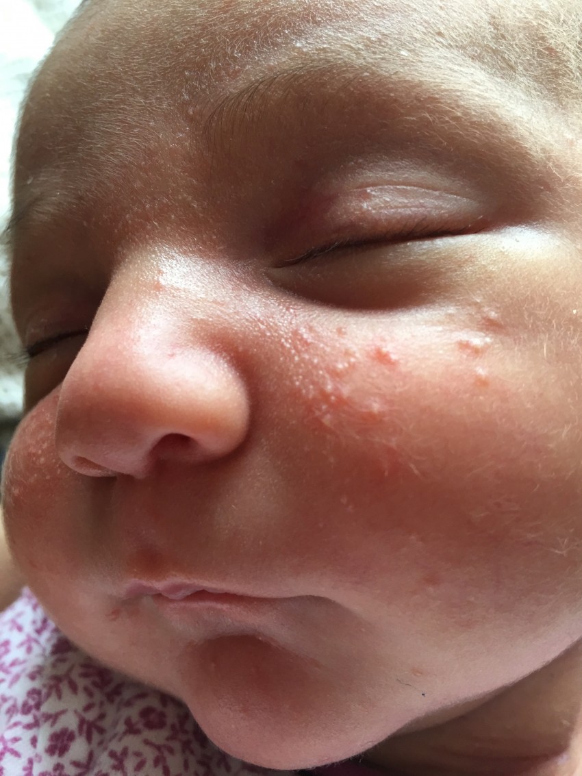 Прыщи у ребенка: 125 фото, поиск причины, варианты лечения проблемы с кожей и принципы лечения болезней кожи