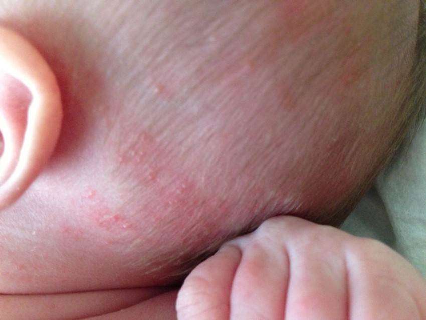 Прыщи у ребенка: 125 фото, поиск причины, варианты лечения проблемы с кожей и принципы лечения болезней кожи