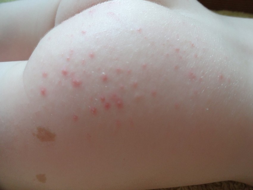 Прыщи у женщин: причины появления и особенности удаления. 110 фото прыщей и советы по медикаментозному лечению