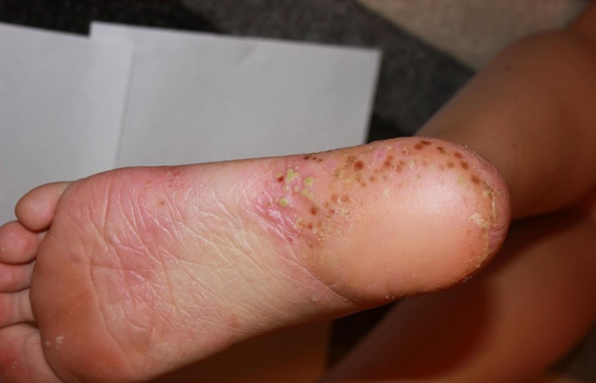 Псориаз в домашних условиях - причины возникновения, диагностика болезни и лечение народными методами (140 фото)