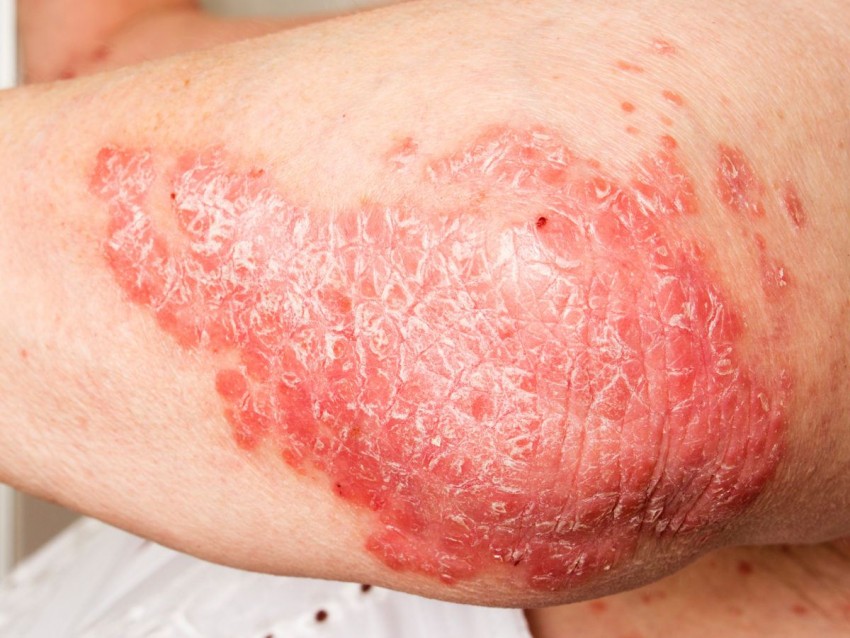 Псориаз в домашних условиях - причины возникновения, диагностика болезни и лечение народными методами (140 фото)