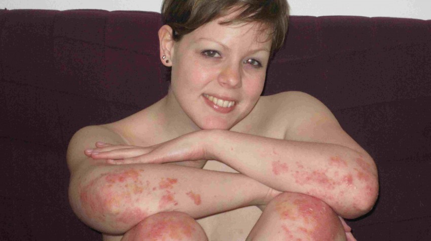 Псориаз в домашних условиях - причины возникновения, диагностика болезни и лечение народными методами (140 фото)