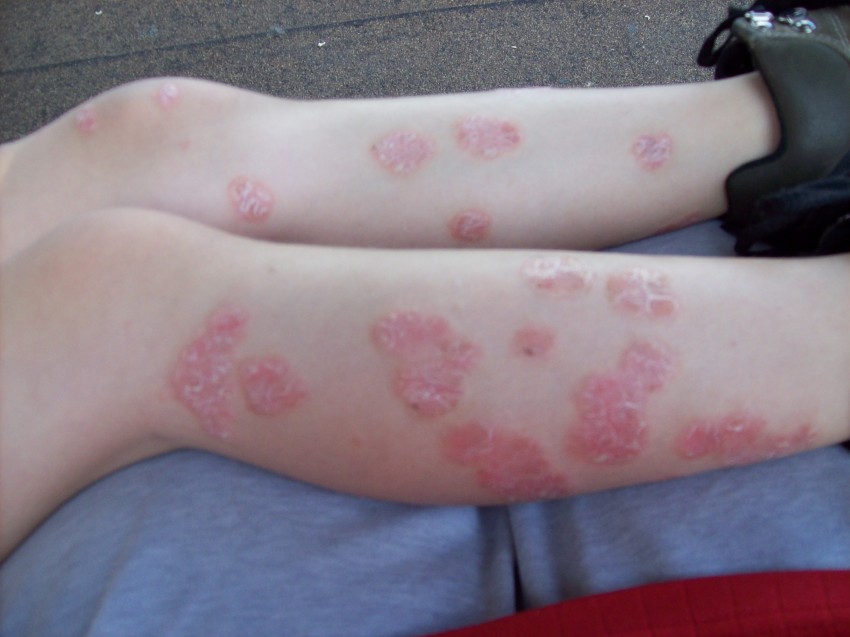 Псориаз в домашних условиях - причины возникновения, диагностика болезни и лечение народными методами (140 фото)