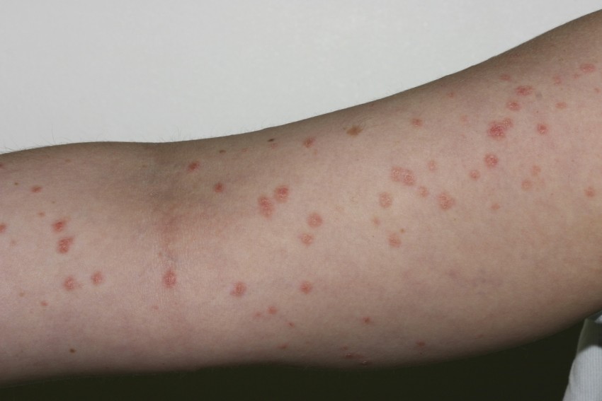 Псориаз кожи: отличительные признаки и особенности лечения болезни в домашних условиях (110 фото и видео)