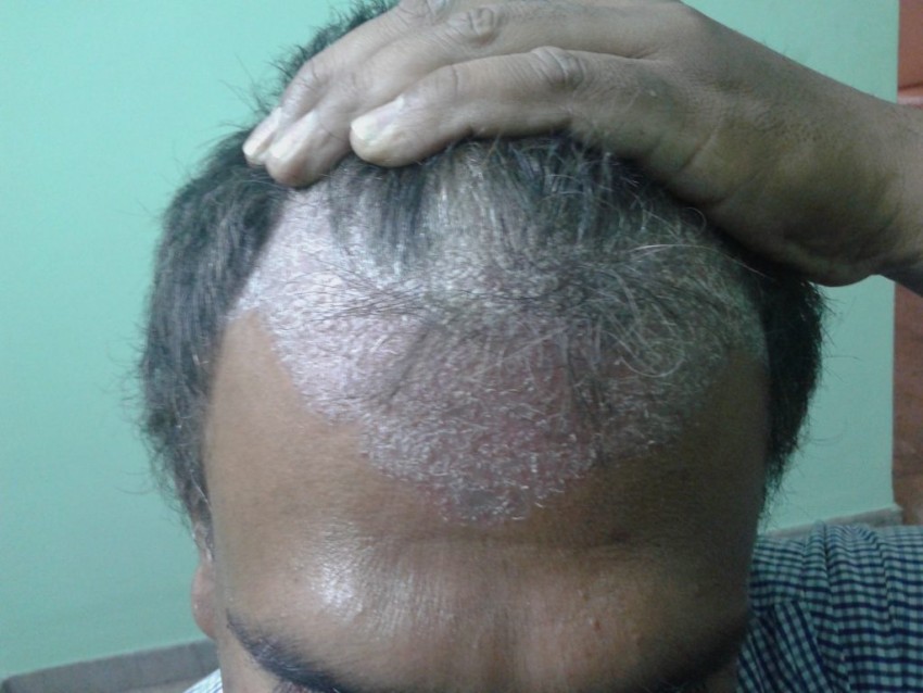 Псориаз на голове: первые симптомы, причины появления, варианты и советы по выбору средства для лечения (95 фото)