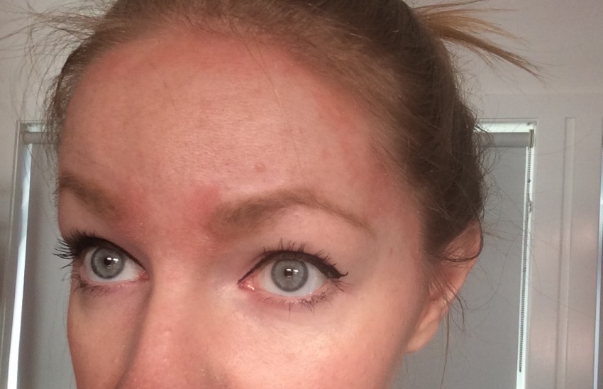 Псориаз на голове: первые симптомы, причины появления, варианты и советы по выбору средства для лечения (95 фото)