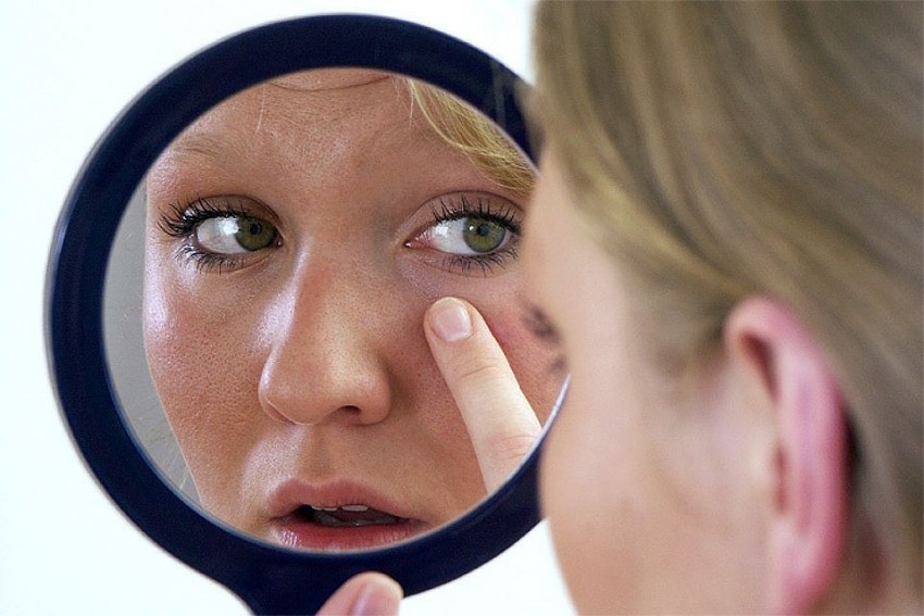 Псориаз на лице - стадии развития и советы дерматологов как и чем быстро и эффективно вылечить псориаз (110 фото)