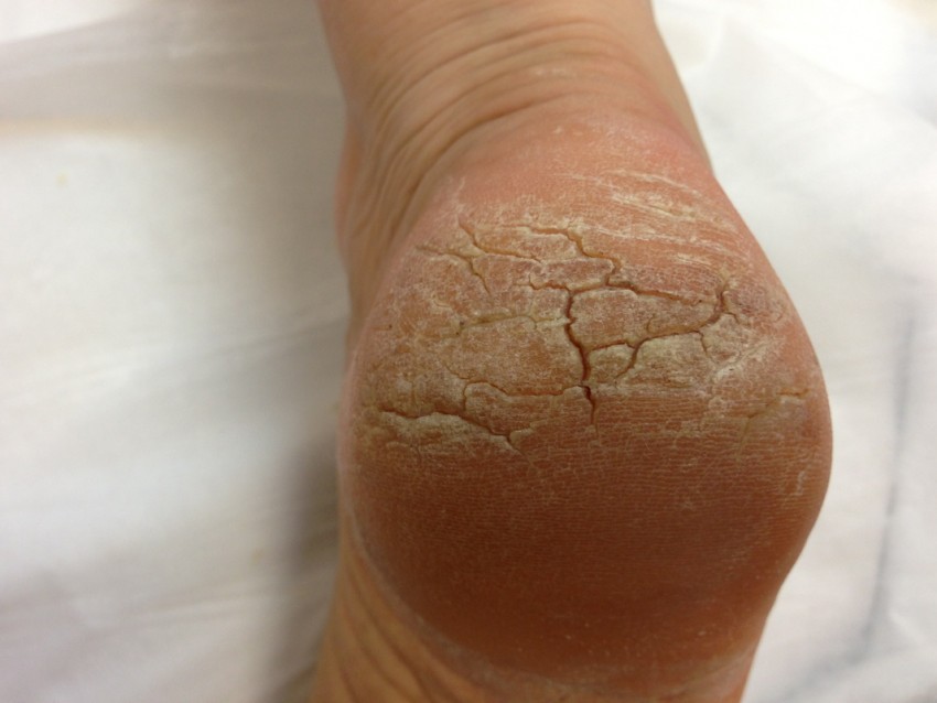 Псориаз на ногах - первые симптомы, классификация болезни, виды проявлений и советы по лечению (100 фото)