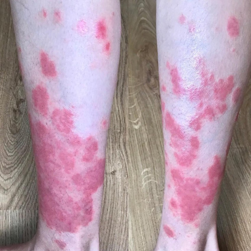 Псориаз на ногах - первые симптомы, классификация болезни, виды проявлений и советы по лечению (100 фото)