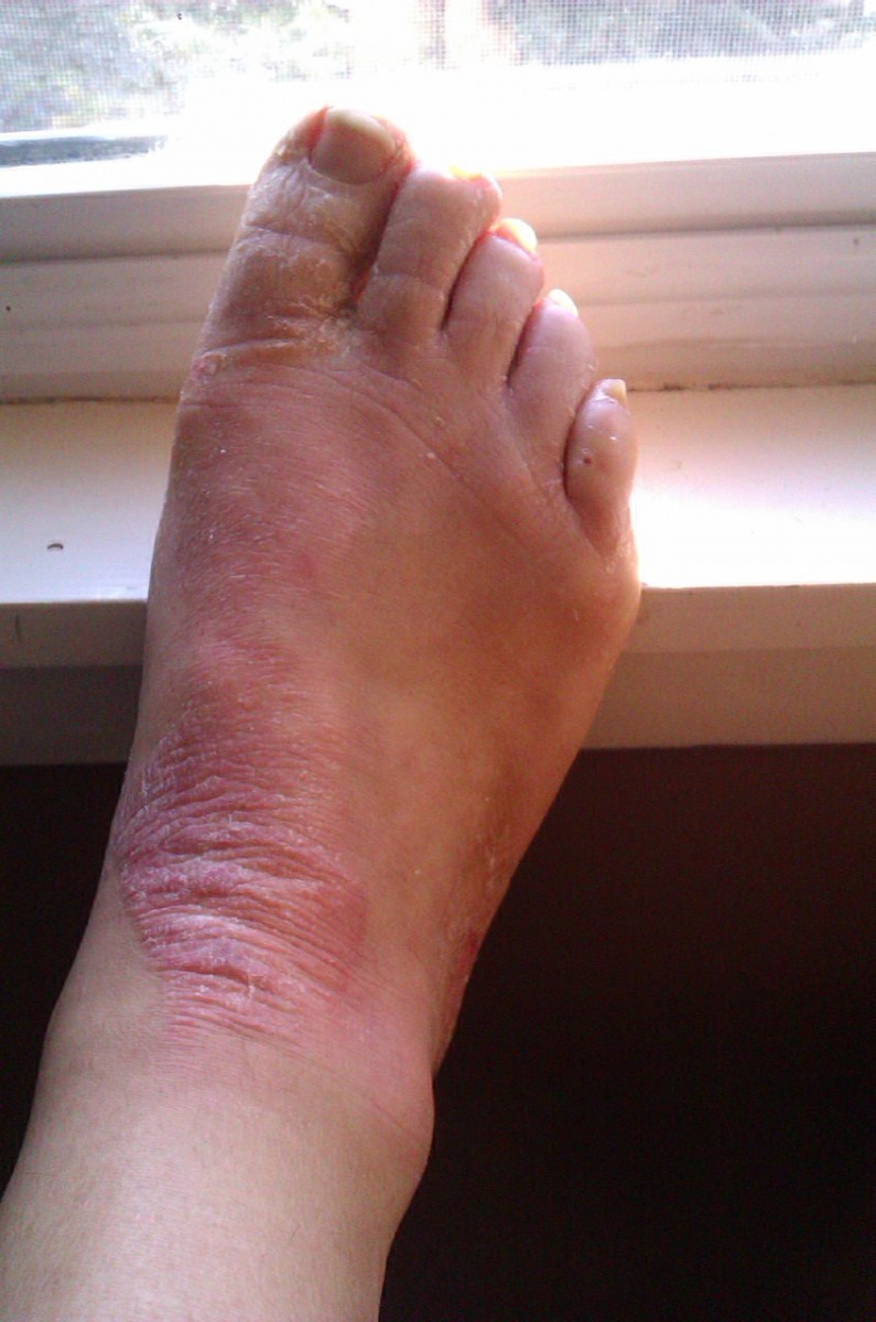 Псориаз на ногах - первые симптомы, классификация болезни, виды проявлений и советы по лечению (100 фото)