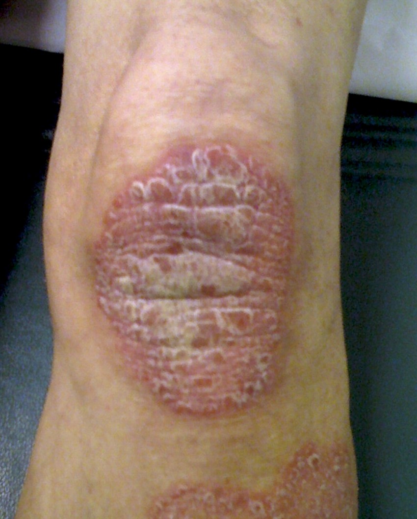 Псориаз на ногах - первые симптомы, классификация болезни, виды проявлений и советы по лечению (100 фото)