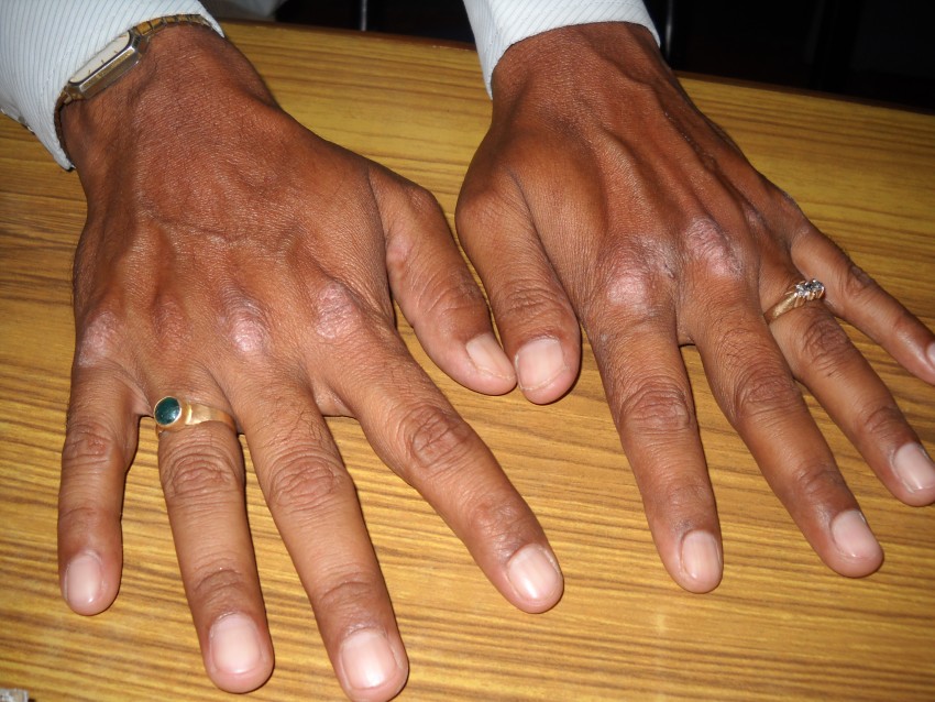 Псориаз на руках: начальные стадии, симптомы, поиск причины и варианты лечения современными средствами (85 фото)