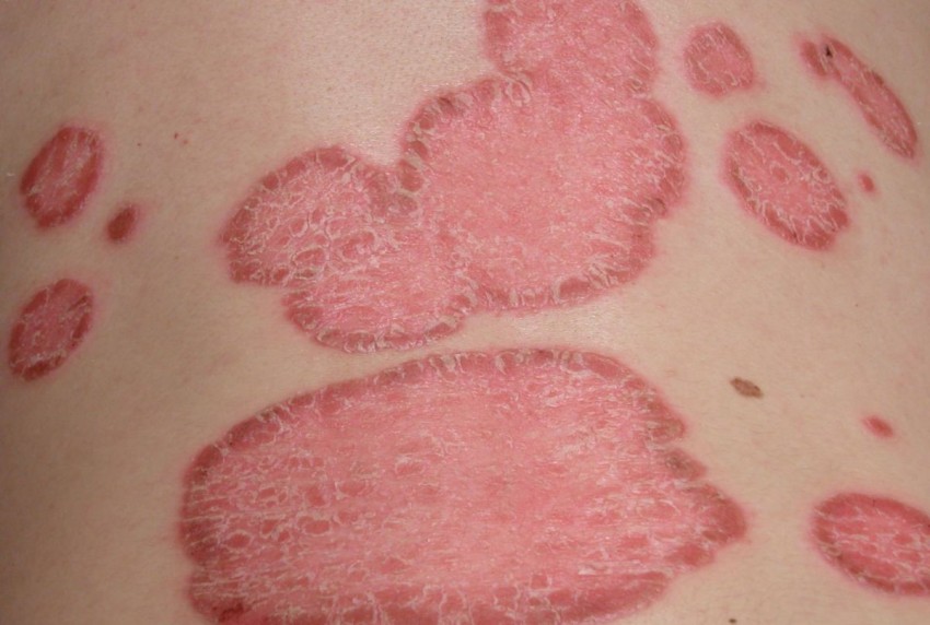 Псориаз у детей - начальные стадии, признаки развития, симптомы и варианты лечения. 110 фото и меры профилактики