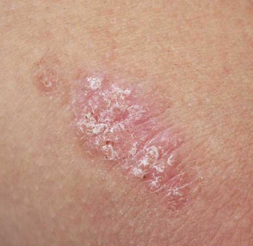 Псориаз у детей - начальные стадии, признаки развития, симптомы и варианты лечения. 110 фото и меры профилактики