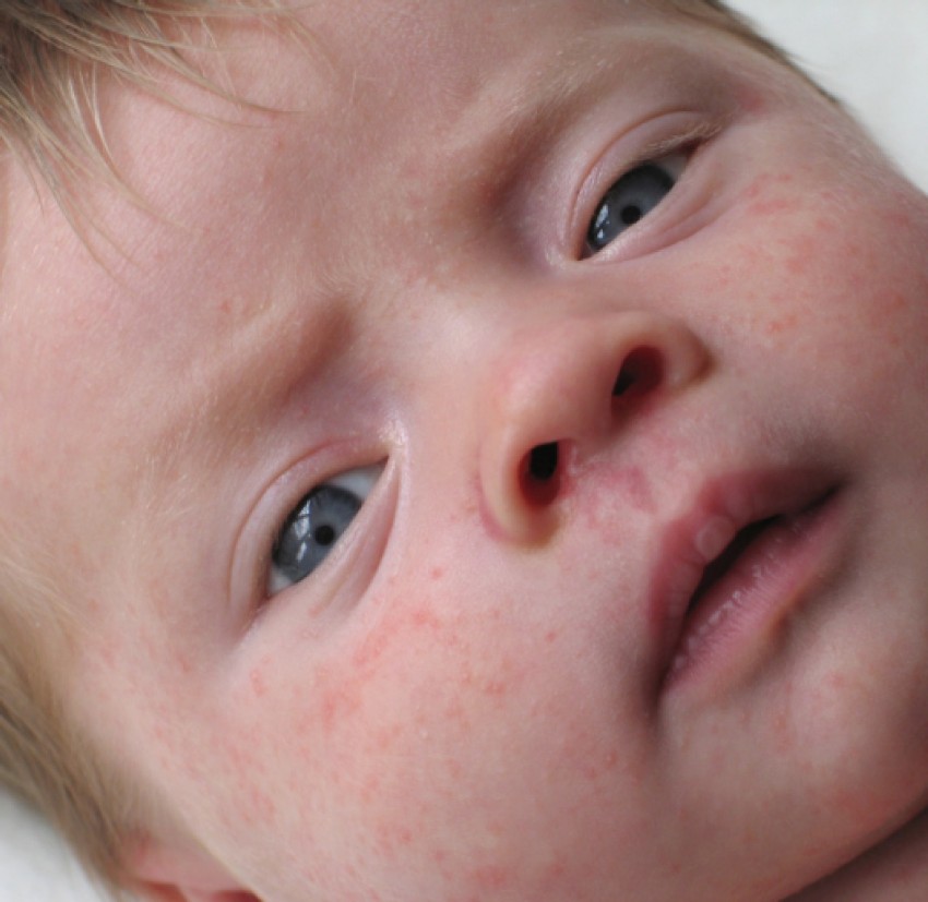 Псориаз у детей - начальные стадии, признаки развития, симптомы и варианты лечения. 110 фото и меры профилактики