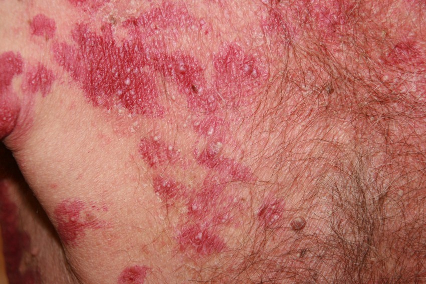Псориаз у взрослых: причины появления, диагностика, симптомы начальной стадии и признаки развития болезни (85 фото и видео)