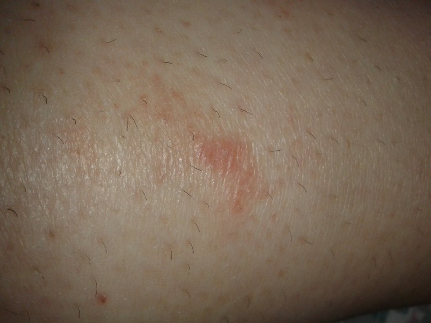 Псориаз у взрослых: причины появления, диагностика, симптомы начальной стадии и признаки развития болезни (85 фото и видео)