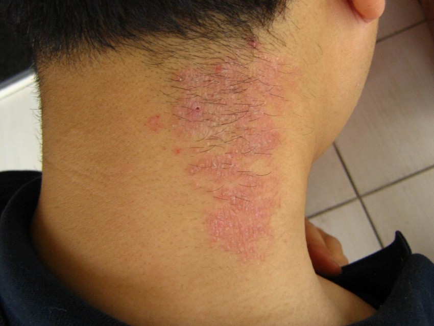 Псориаз у взрослых: причины появления, диагностика, симптомы начальной стадии и признаки развития болезни (85 фото и видео)