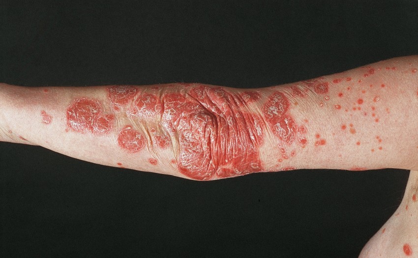 Псориаз у взрослых: причины появления, диагностика, симптомы начальной стадии и признаки развития болезни (85 фото и видео)