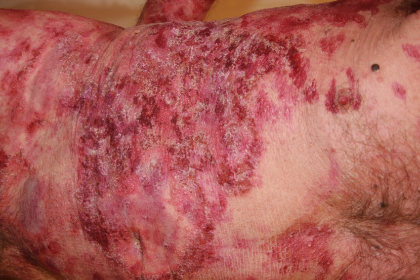 Псориаз у взрослых: причины появления, диагностика, симптомы начальной стадии и признаки развития болезни (85 фото и видео)