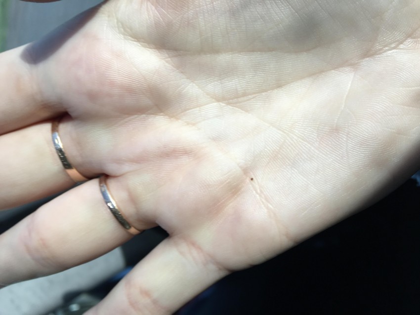 Родинка на ладони: типы, свойства и виды родинок. Как отличить опасные и безопасные родинки (115 фото)