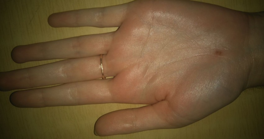 Родинка на ладони: типы, свойства и виды родинок. Как отличить опасные и безопасные родинки (115 фото)