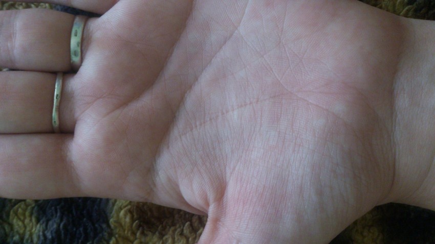 Родинка на ладони: типы, свойства и виды родинок. Как отличить опасные и безопасные родинки (115 фото)