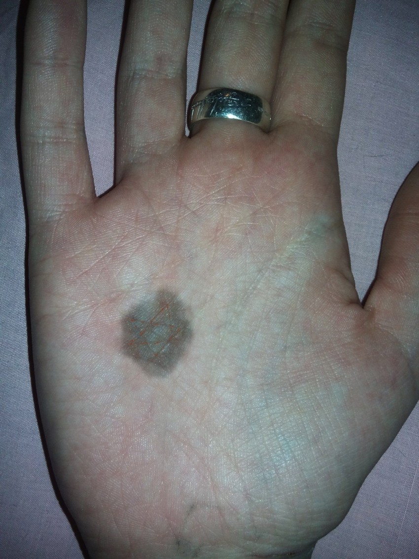 Родинка на ладони: типы, свойства и виды родинок. Как отличить опасные и безопасные родинки (115 фото)