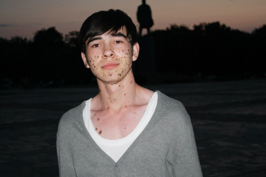 Родинка на шее: виды, причины появления, сложности диагностики онкологии и варианты удаления родинок (75 фото + видео)