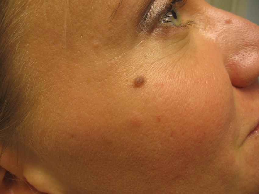 Родинка на щеке - что означает, варианты удаления, причины появления и особенности диагностики родинок (105 фото)
