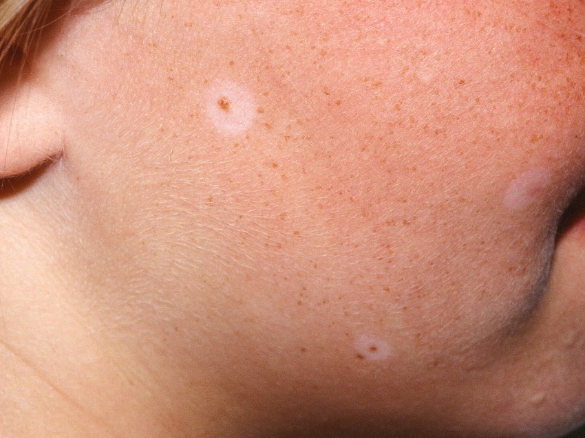 Родинка на щеке - что означает, варианты удаления, причины появления и особенности диагностики родинок (105 фото)