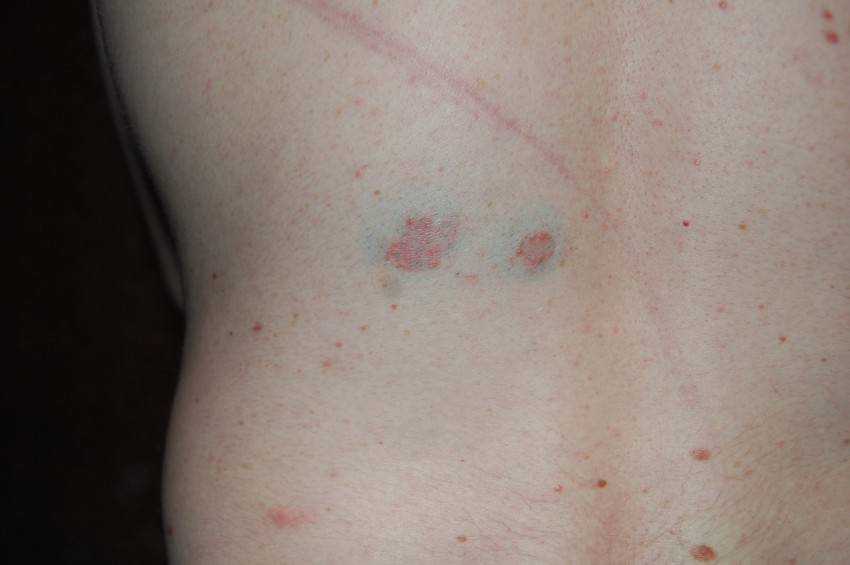 Родинка на спине: как выглядит и где проверить родинку на онкологию. 100 фото и видео рекомендации по оценке родинок