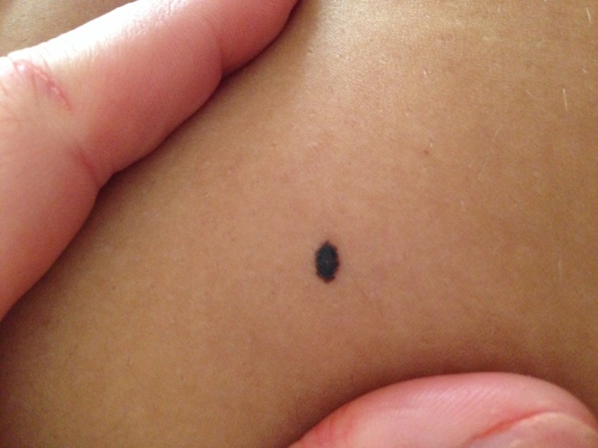 Родинка на спине: как выглядит и где проверить родинку на онкологию. 100 фото и видео рекомендации по оценке родинок