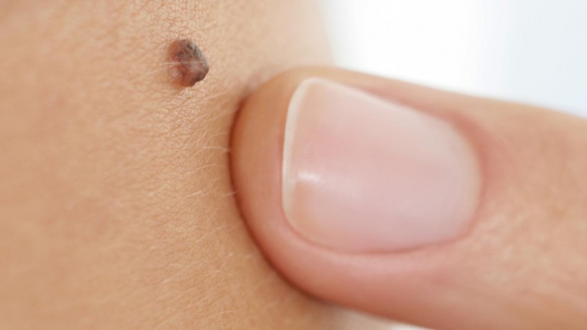 Родинки на теле - описание, строение, как и каким врачом проверяются. Как происходит удаление родинок (видео + 105 фото)