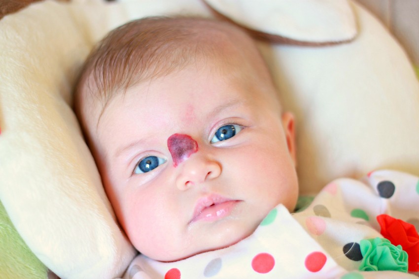 Родинки у детей - где проверяются родинки у новорожденных и дошкольников? Причины появления, 120 фото и видео родинок