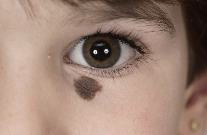 Родинки у детей - где проверяются родинки у новорожденных и дошкольников? Причины появления, 120 фото и видео родинок