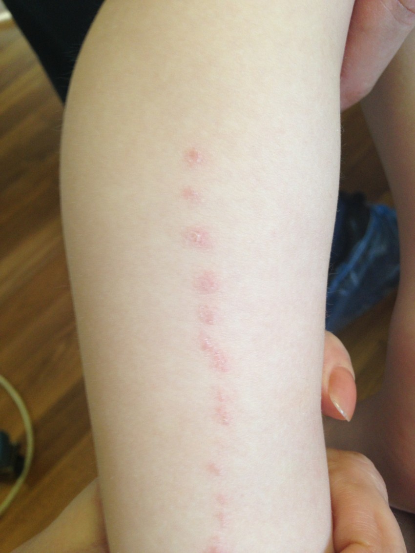 Розовый лишай: причины появления, основные симптомы, варианты лечения и советы по выбору препарата (100 фото)