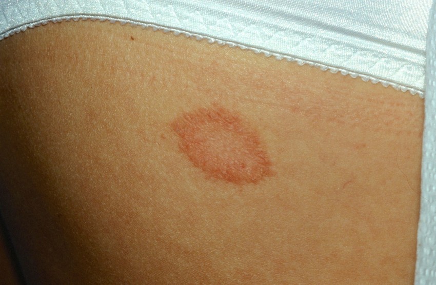 Розовый лишай: причины появления, основные симптомы, варианты лечения и советы по выбору препарата (100 фото)