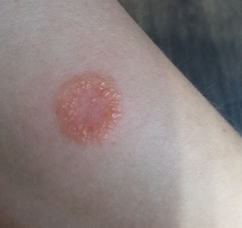 Розовый лишай: причины появления, основные симптомы, варианты лечения и советы по выбору препарата (100 фото)