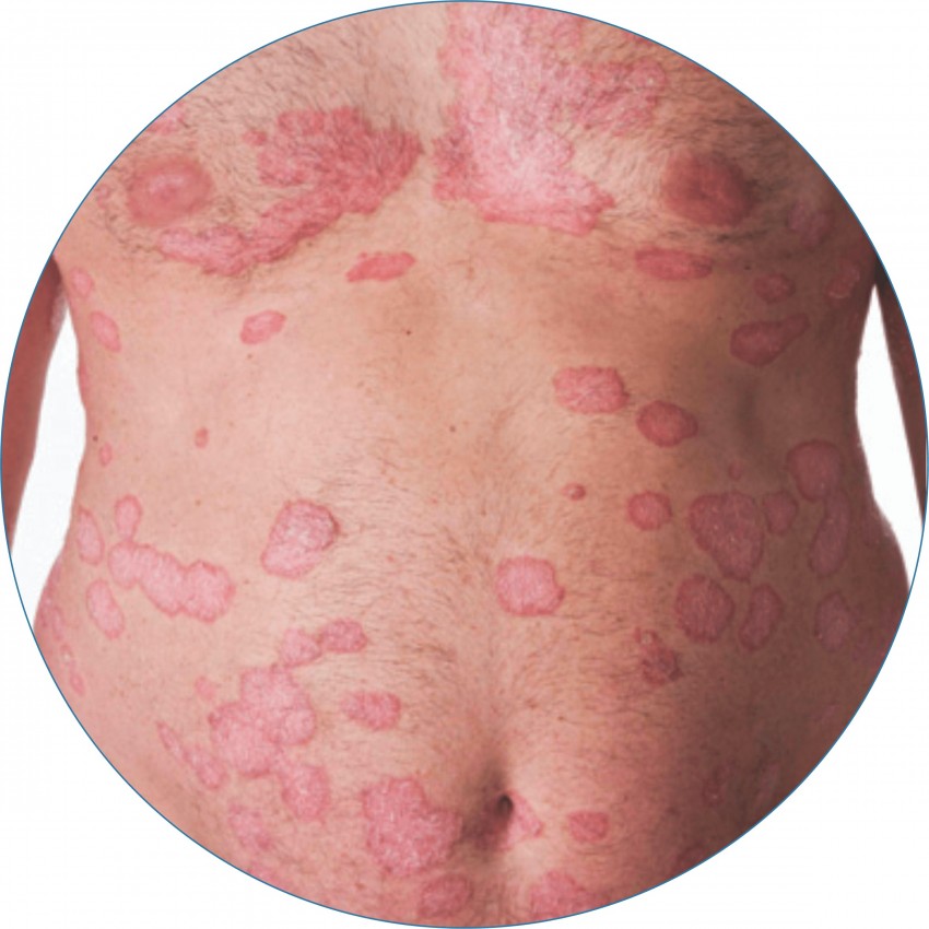 Симптомы псориаза - описание болезни, диагностика и правила лечения. Отличия от других кожных заболеваний и советы по выбору лекарства (105 фото)