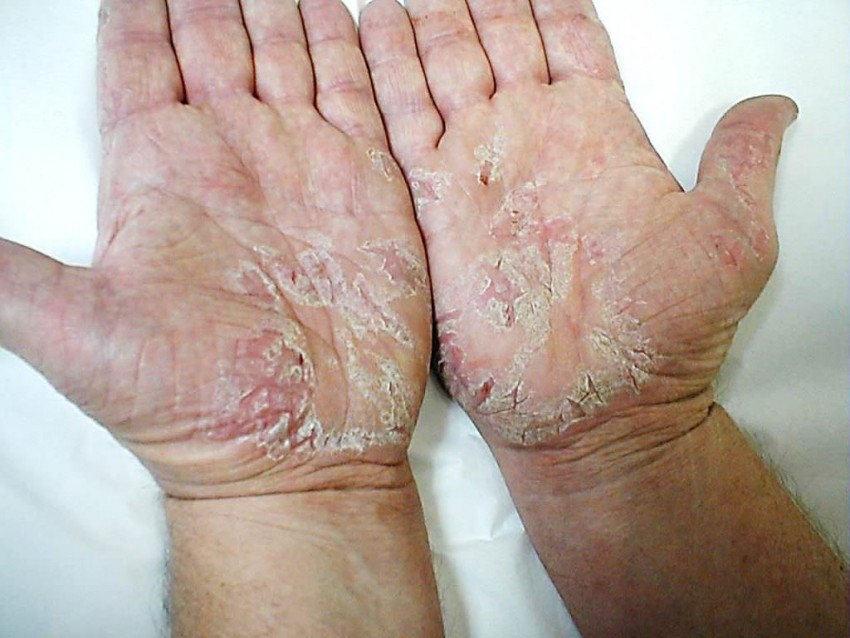 Симптомы псориаза - описание болезни, диагностика и правила лечения. Отличия от других кожных заболеваний и советы по выбору лекарства (105 фото)