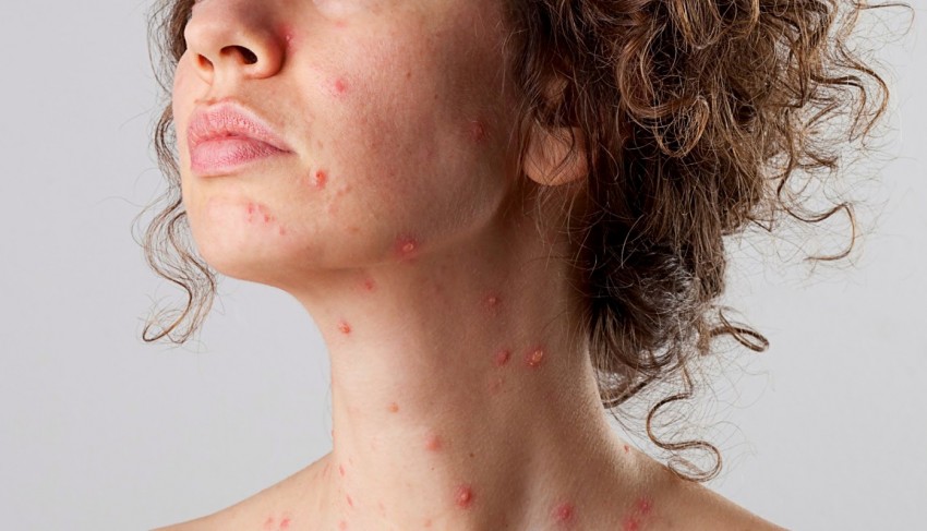 Симптомы ветрянки - своевременная диагностика и обнаружение ветряной оспы. 125 фото и советы врачей по выбору средств для лечения