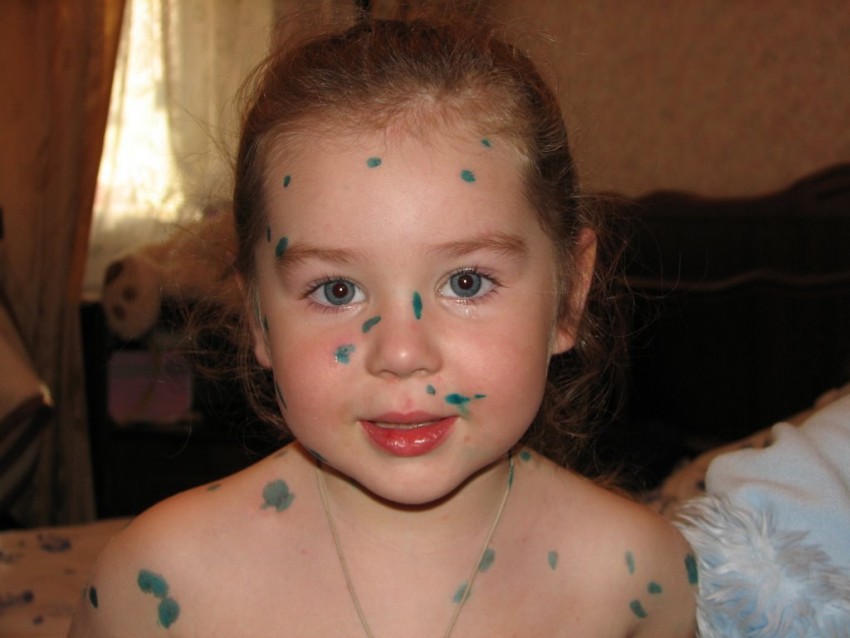 Симптомы ветрянки - своевременная диагностика и обнаружение ветряной оспы. 125 фото и советы врачей по выбору средств для лечения